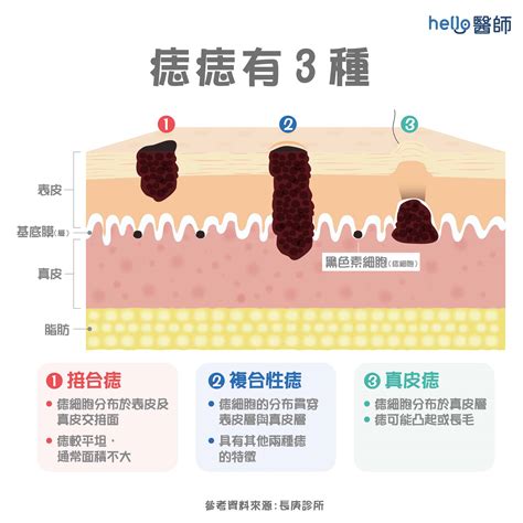 內痣是什麼|痣是什麼？一次了解痣原因、就醫時機以及如何改善